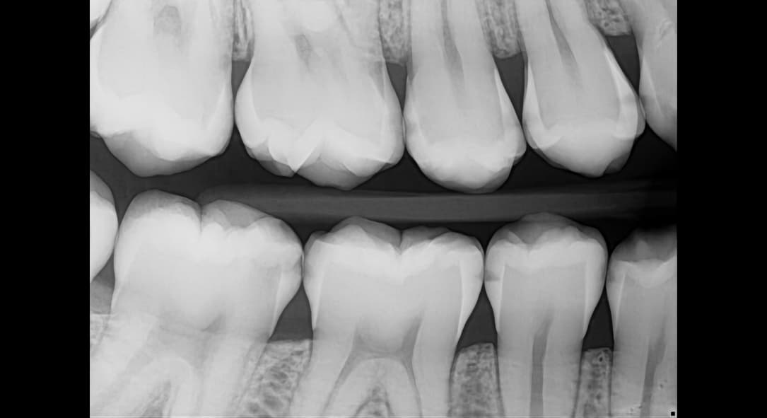 Example - Adult Bitewing with AI