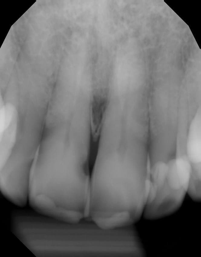 Example - Adult Periapical with AI