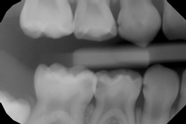 Example - Pediatric Bitewing with AI