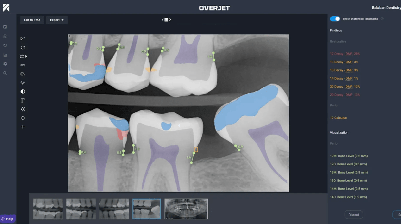 Overjet vs Pearl AI: Definitive Comparison 2026