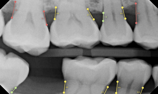 Normal Bone Level Radiograph Dental AI Software for Dentists | Overjet